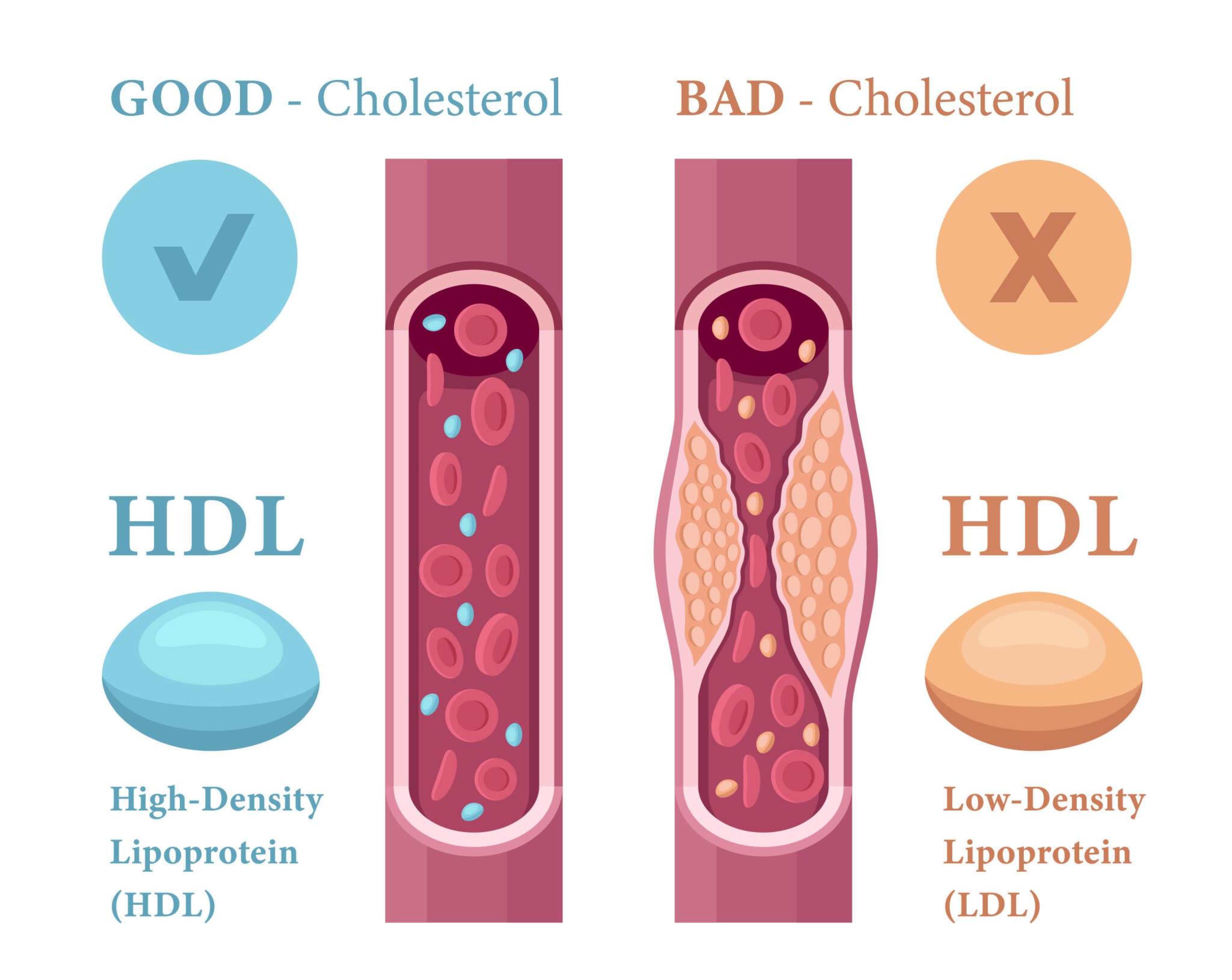 lipid panel c hdl meaning , Good cholesterol, Med Lab Zone , #HDL #goodcholesterol #lipids #hearthealth #medlab #labscience #USAhealth Understanding Healthy Cholesterol Levels By